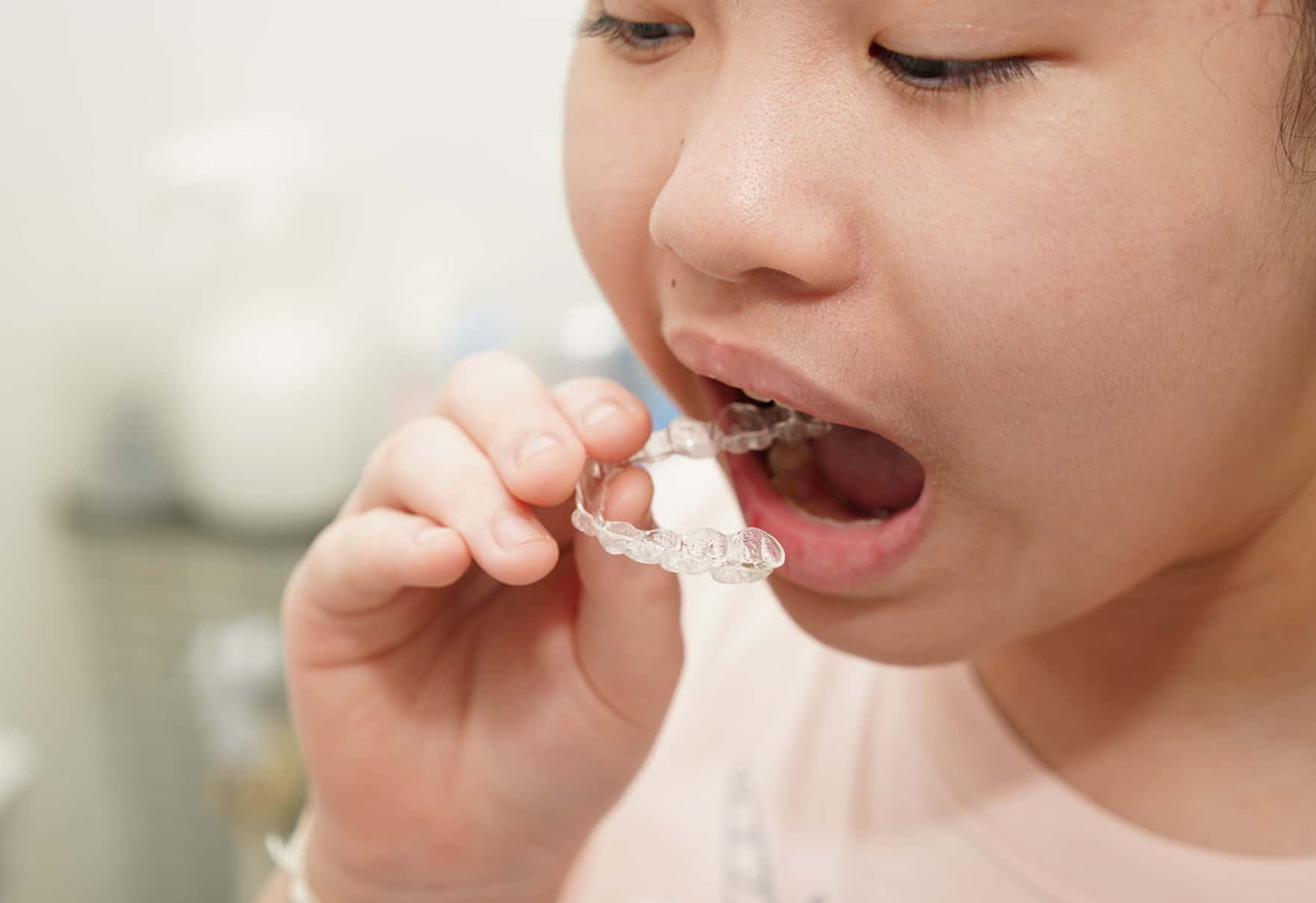 インビザライン・ファースト:1期治療(6歳〜10歳)