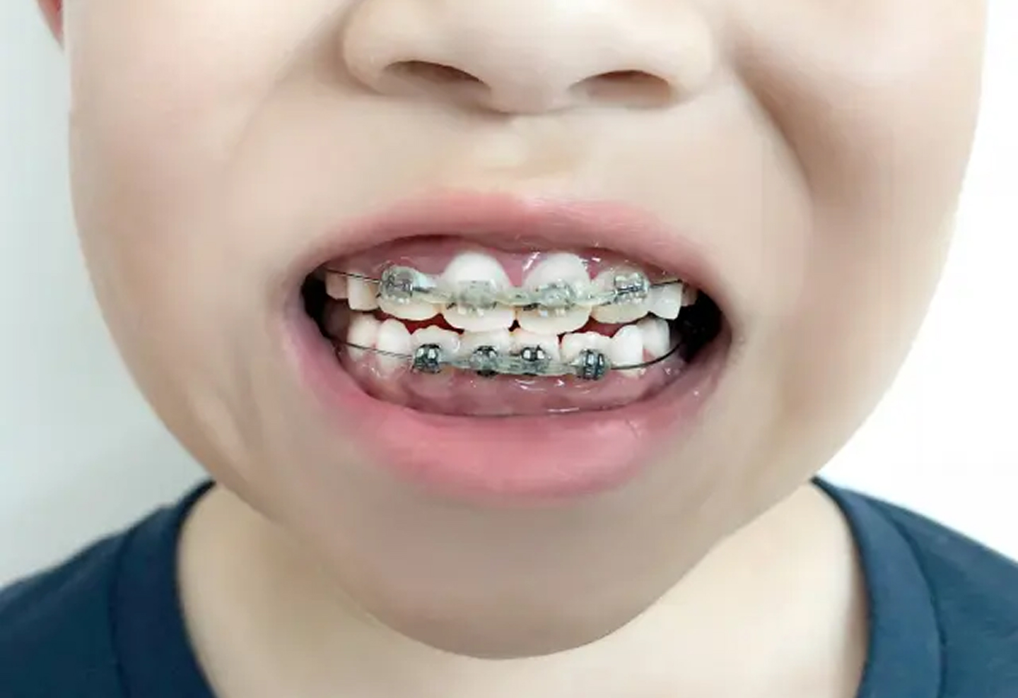 ワイヤー矯正:2期治療(12〜13歳以降治療開始)