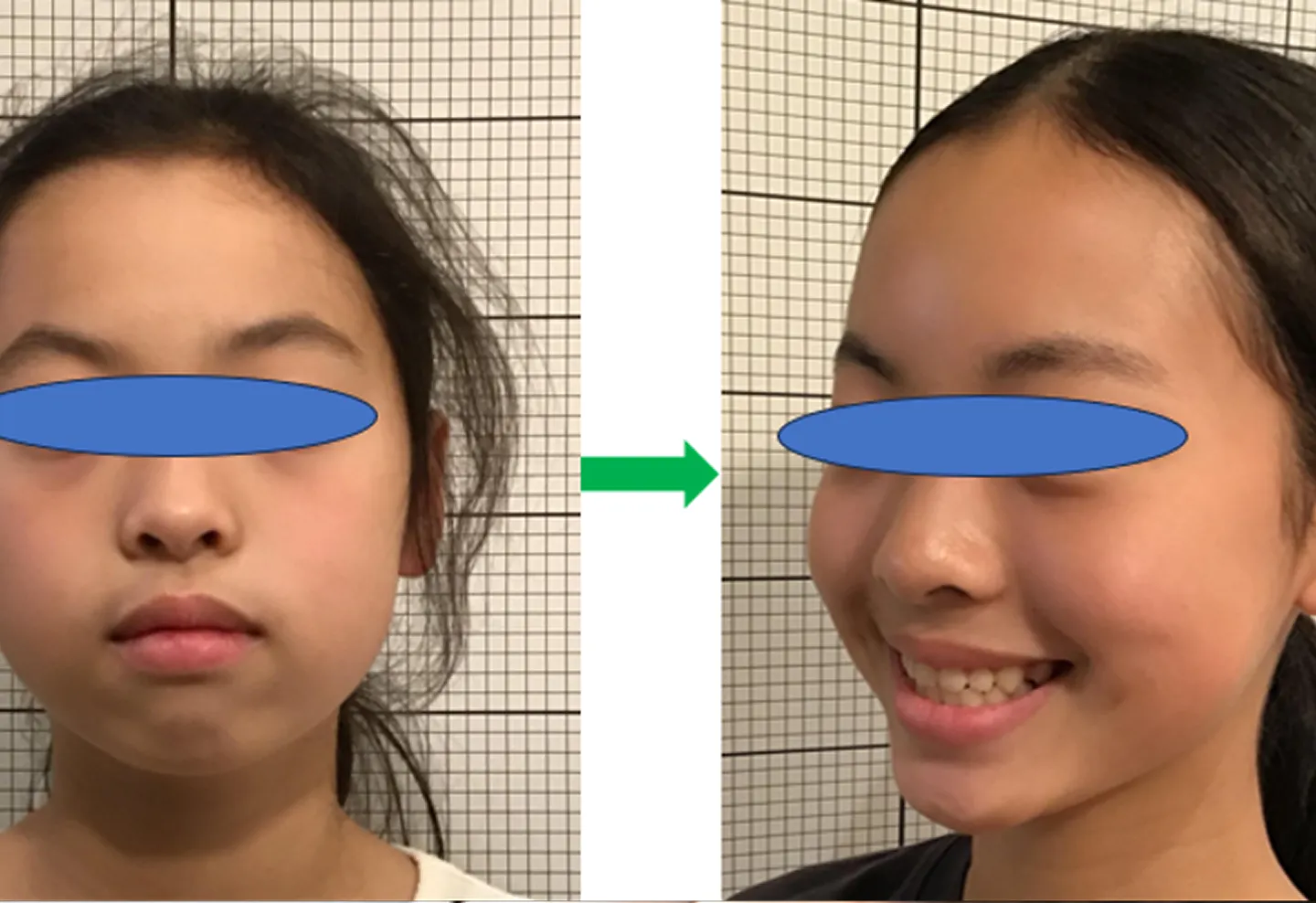 悪習癖を改善し歯戻りが少ない小児矯正治療が可能